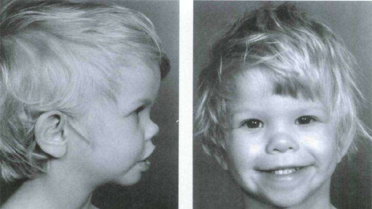 Características faciales comunes de un niño con síndrome de Williams