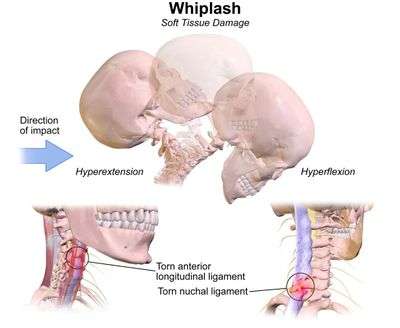 Lesiones por latigazo cervical.jpg