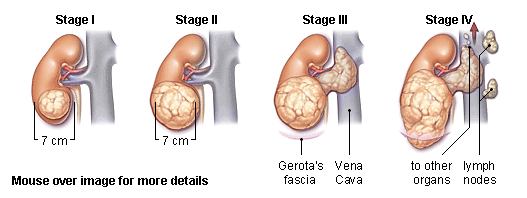 Tumor de Wilms