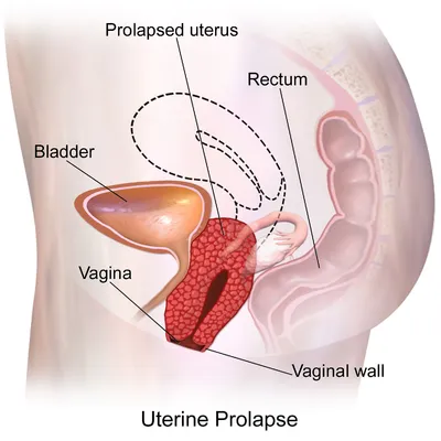 Diagrama de prolapso uterino.png