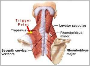 Trapezius gatillo puntos.jpg