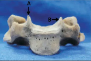 Articulaciones novertebrales