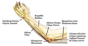 Atrapamiento del nervio cubital
