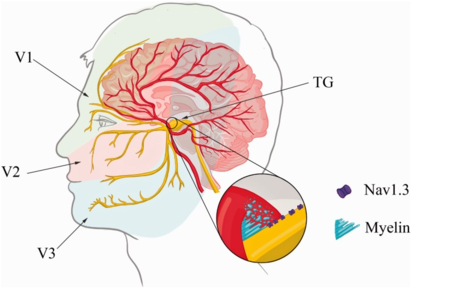 Neuralgia del Trigémino: un estudio de caso