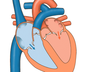 Extrasístole ventricular