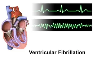 Fibrilación ventricular