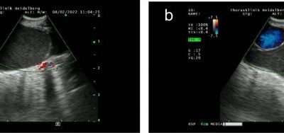 Linfangiomatosis pulmonar: conocimientos sobre una enfermedad ultrarara