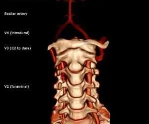 Prueba de arteria vertebral