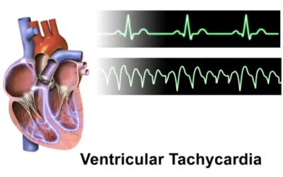 Taquicardia ventricular