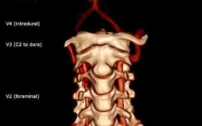 arteria vertebral