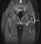 Bursitis trocánterica