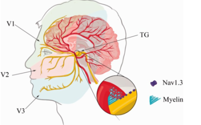 Neuralgia del Trigémino: un estudio de caso