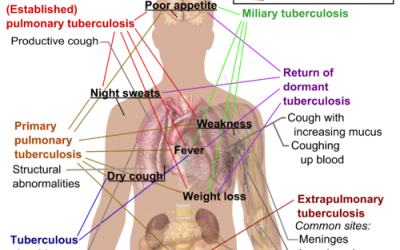 Tuberculosis