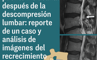 Osificación en puente intracanal después de la descompresión lumbar: reporte de un caso y análisis de imágenes del recrecimiento óseo posoperatorio